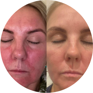 Atopic face skin shea oil