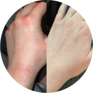 red, itchy, scaly hand skin shea oil